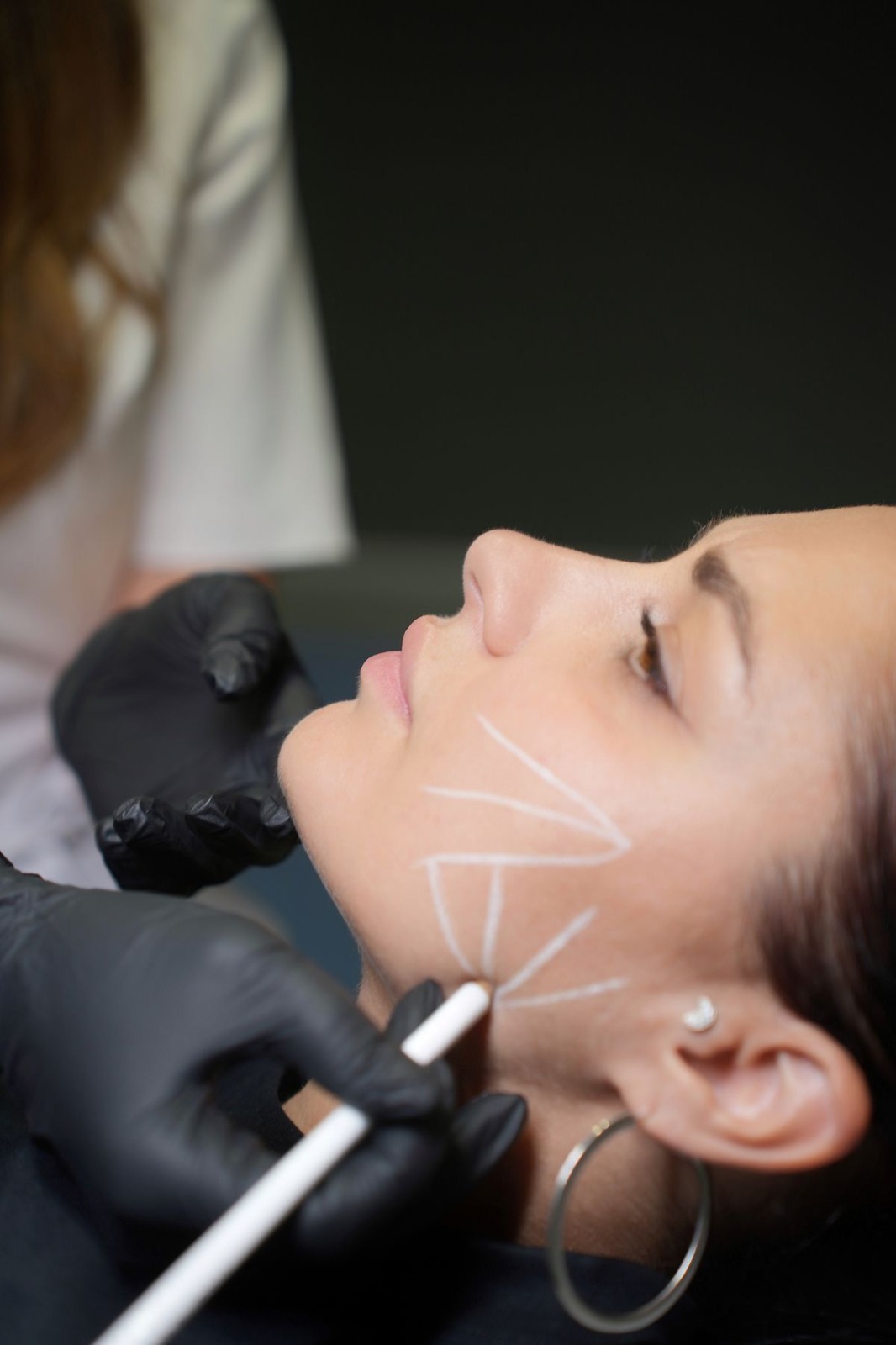 Resultado Harmonização Facial